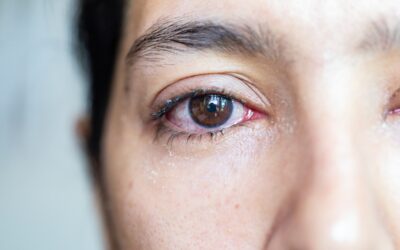 The Unexpected Link Between Watery Eyes and Dry Eye Syndrome