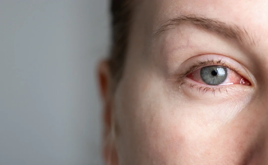 How to Get Rid of Dry Eyes Without Eye Drops