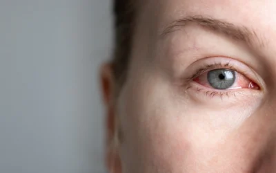 How to Get Rid of Dry Eyes Without Eye Drops